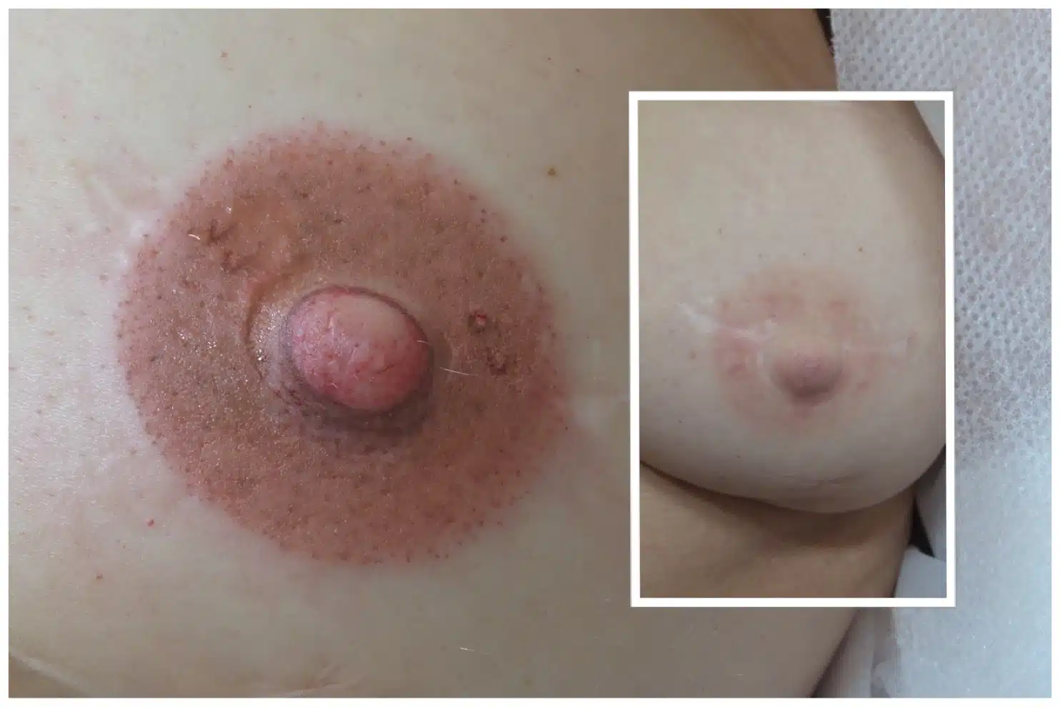 Breast reduction scar camouflage treatment results