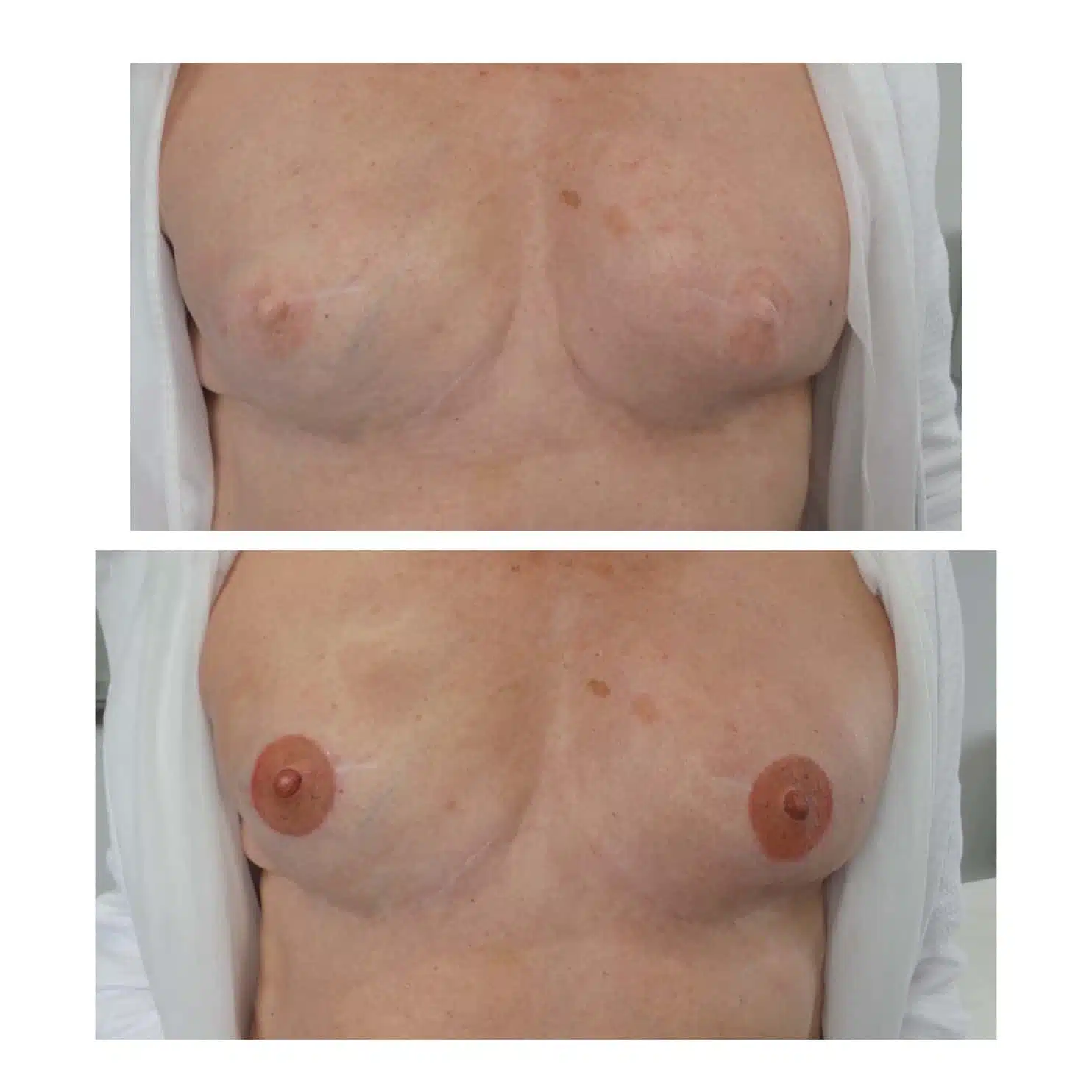 3D areola and nipple tattoo reconstruction results