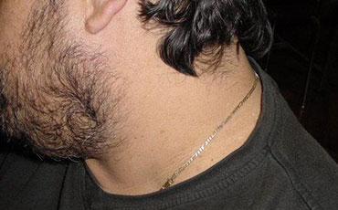 Skin lesion after CryoPen treatment showing clear improvement