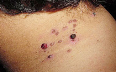 Skin lesion before CryoPen treatment