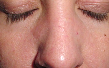Clear skin after CryoPen treatment showing excellent results
