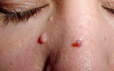 Multiple skin lesions before CryoPen treatment