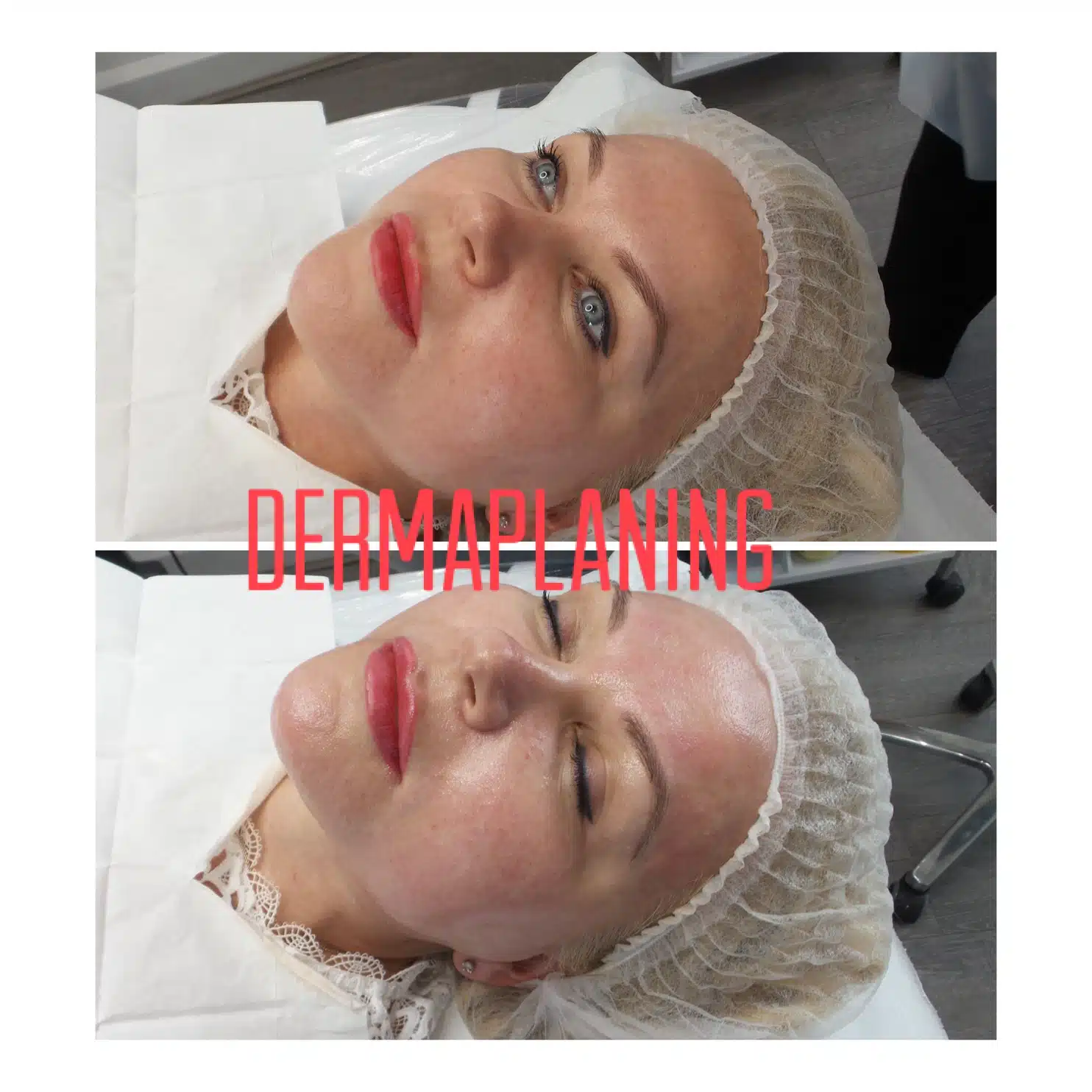Professional dermaplaning treatment process