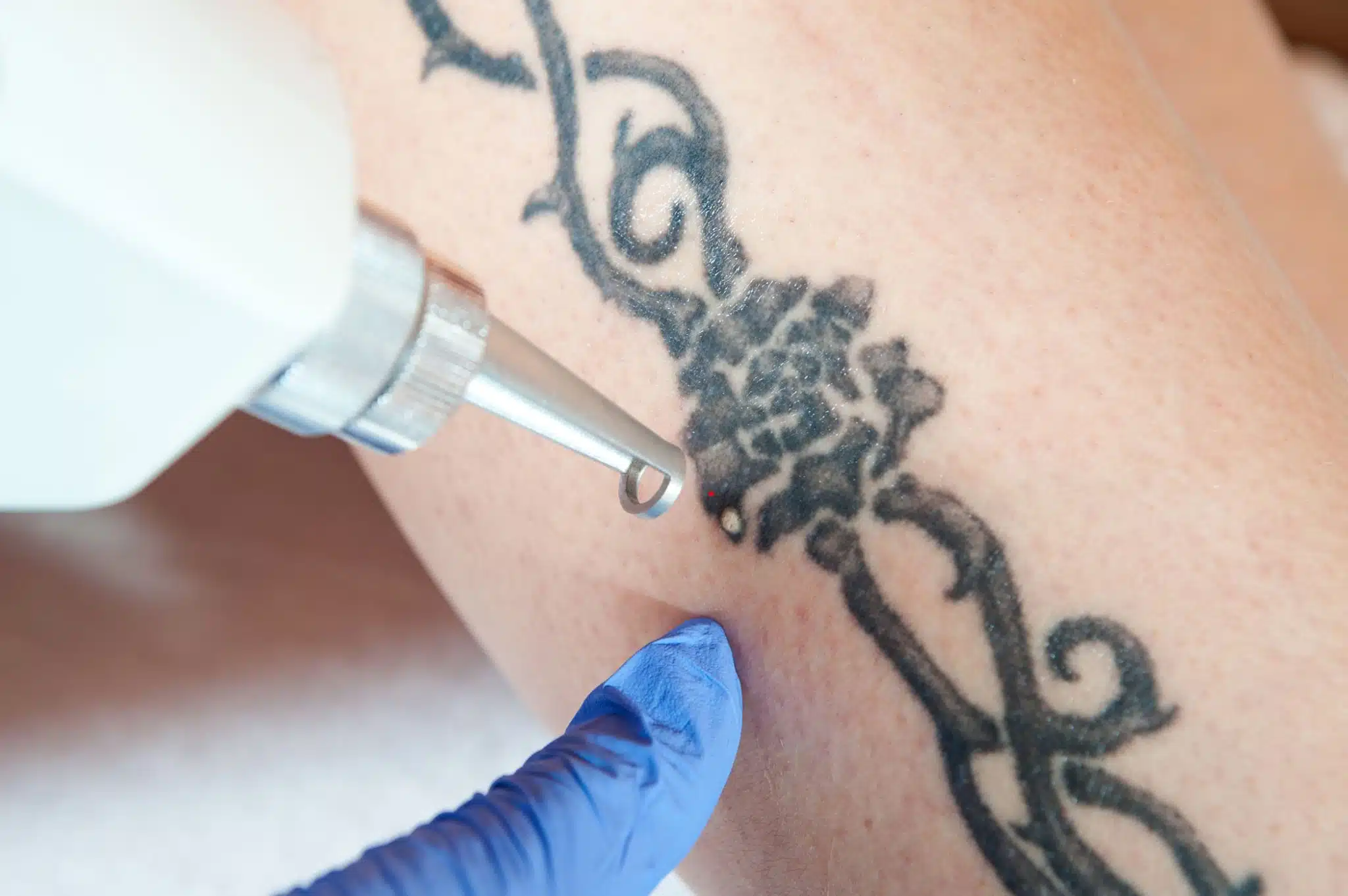 Professional laser tattoo removal treatment in Manchester