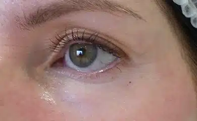 After Meso ME treatment results