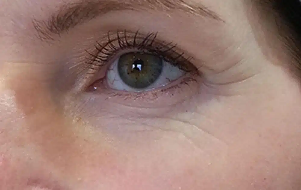Before Meso ME treatment