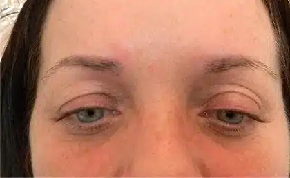 E-Rase tattoo removal - after treatment showing successful removal