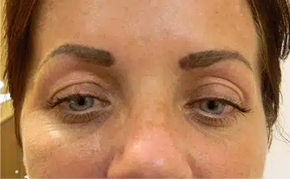 E-Rase tattoo removal - before treatment