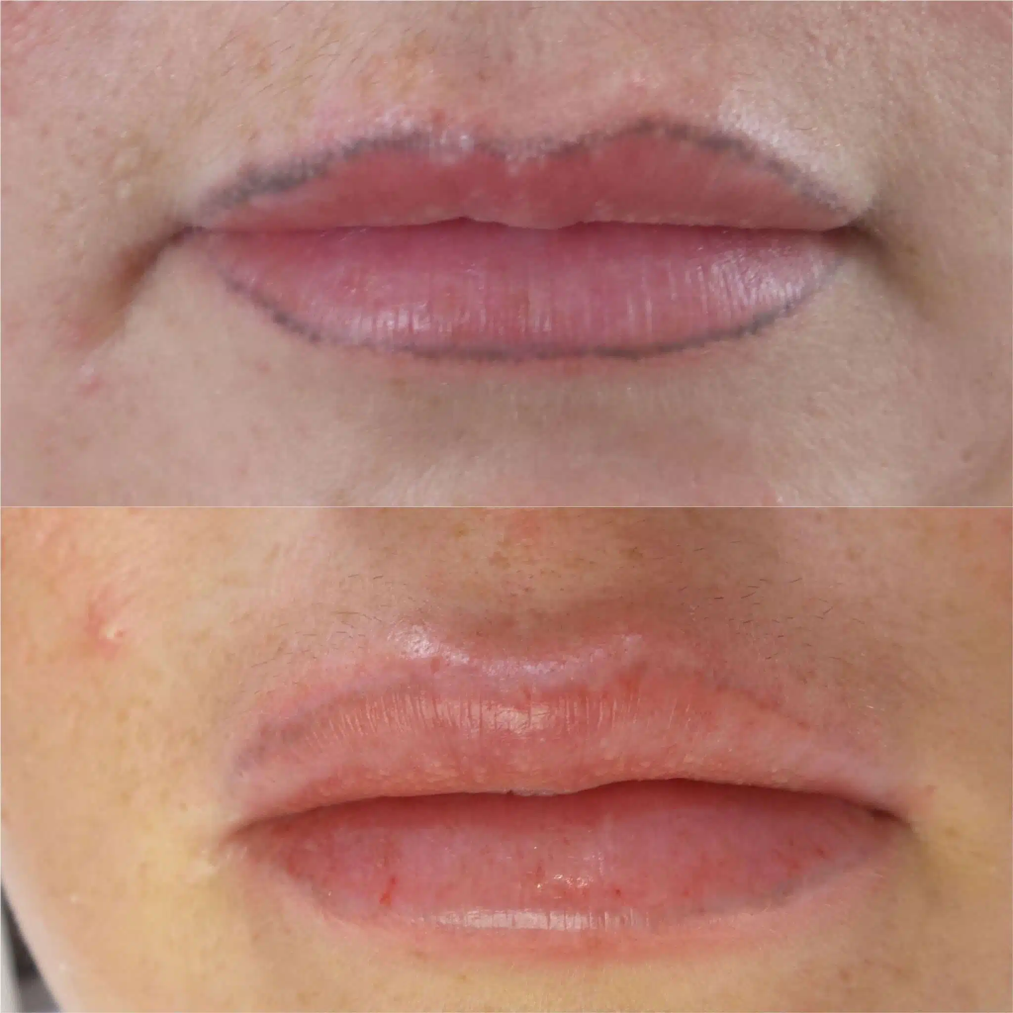 Saline removal technique demonstration
