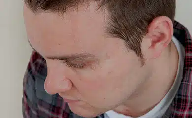 Burns and scars after MCA treatment showing improved appearance