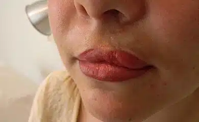 Cleft lip after MCA and micropigmentation treatment