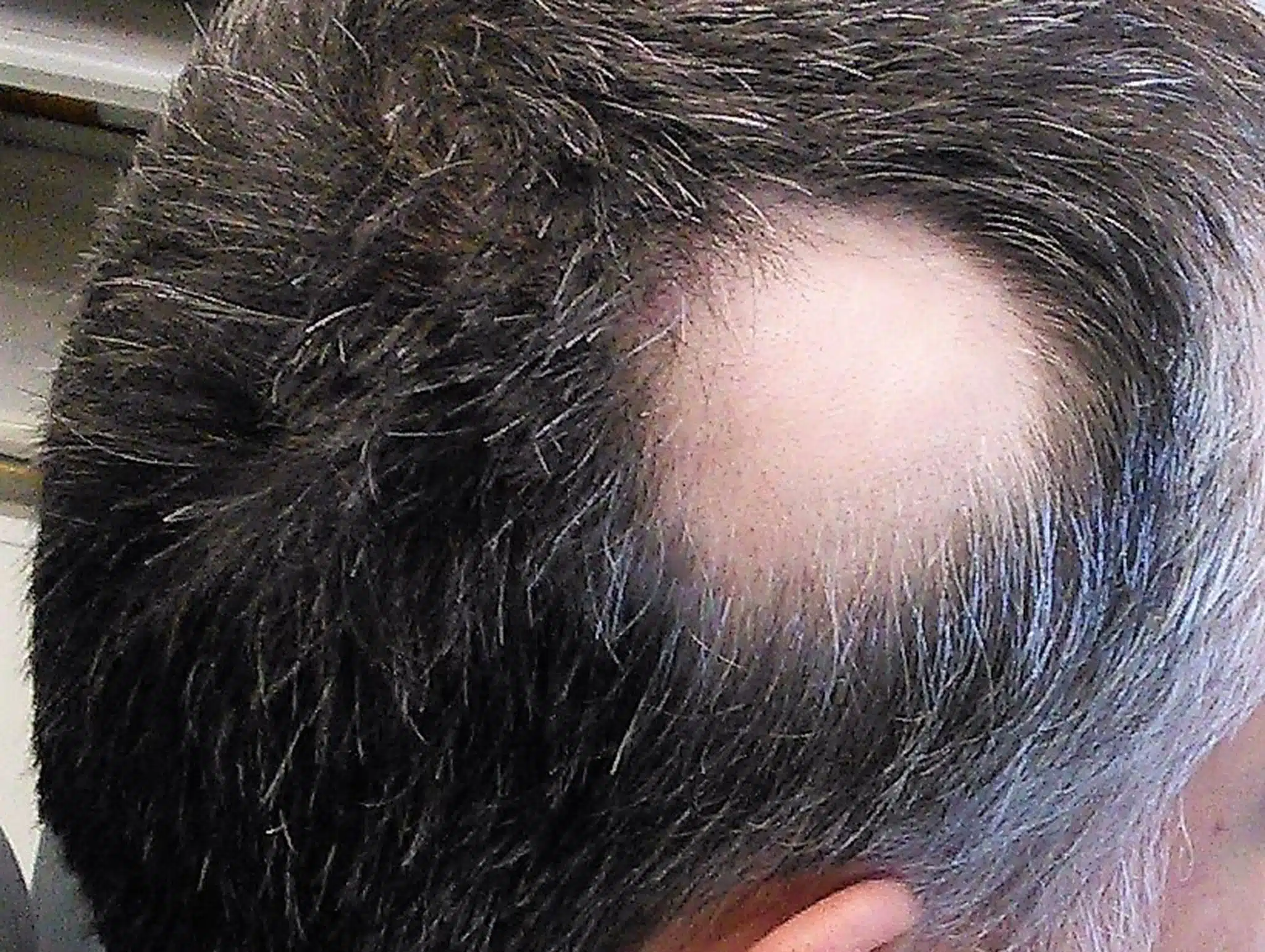 Alopecia treatment results showing natural eyebrow restoration