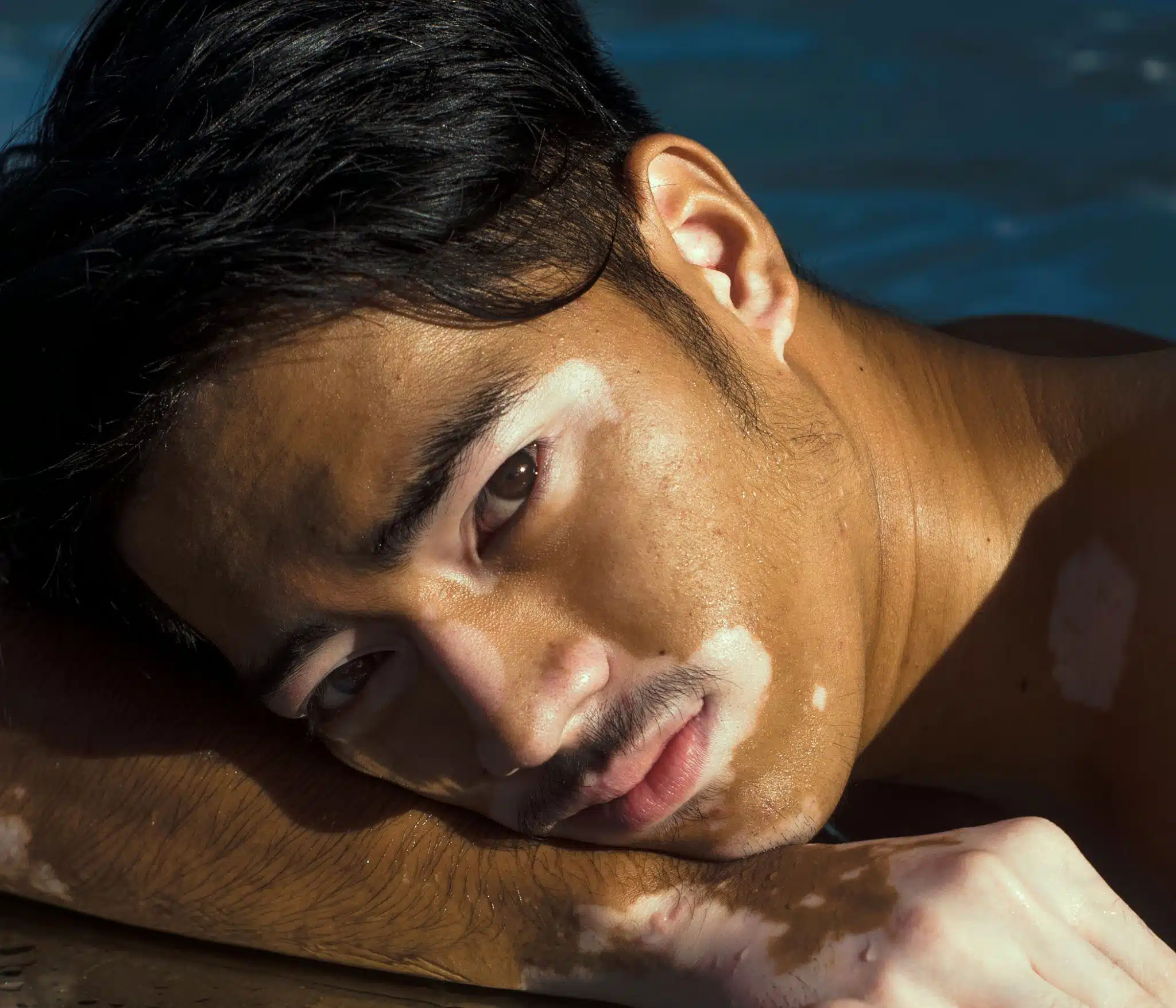 Vitiligo skin condition treatment example