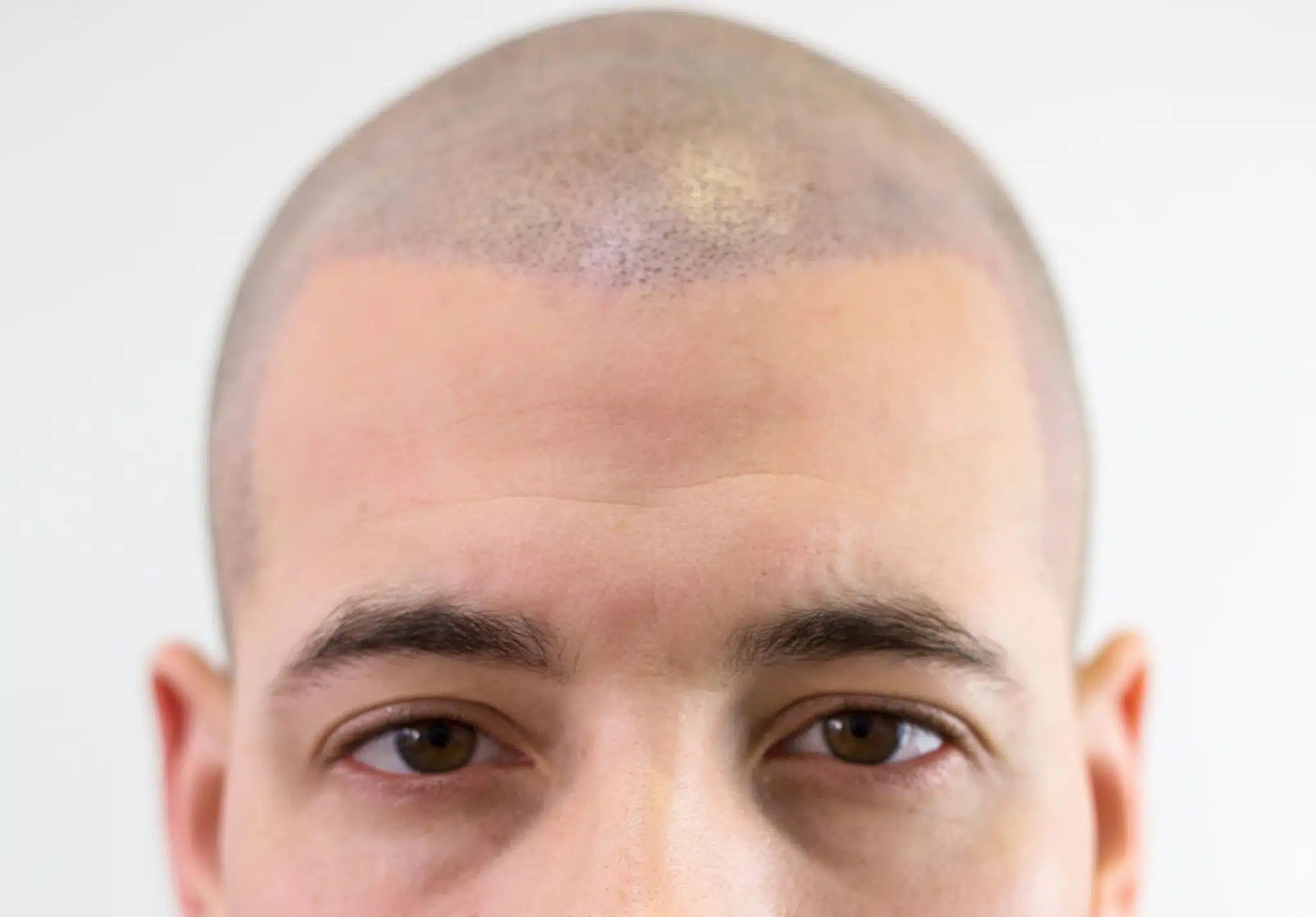 Male scalp micropigmentation results showing natural hair appearance