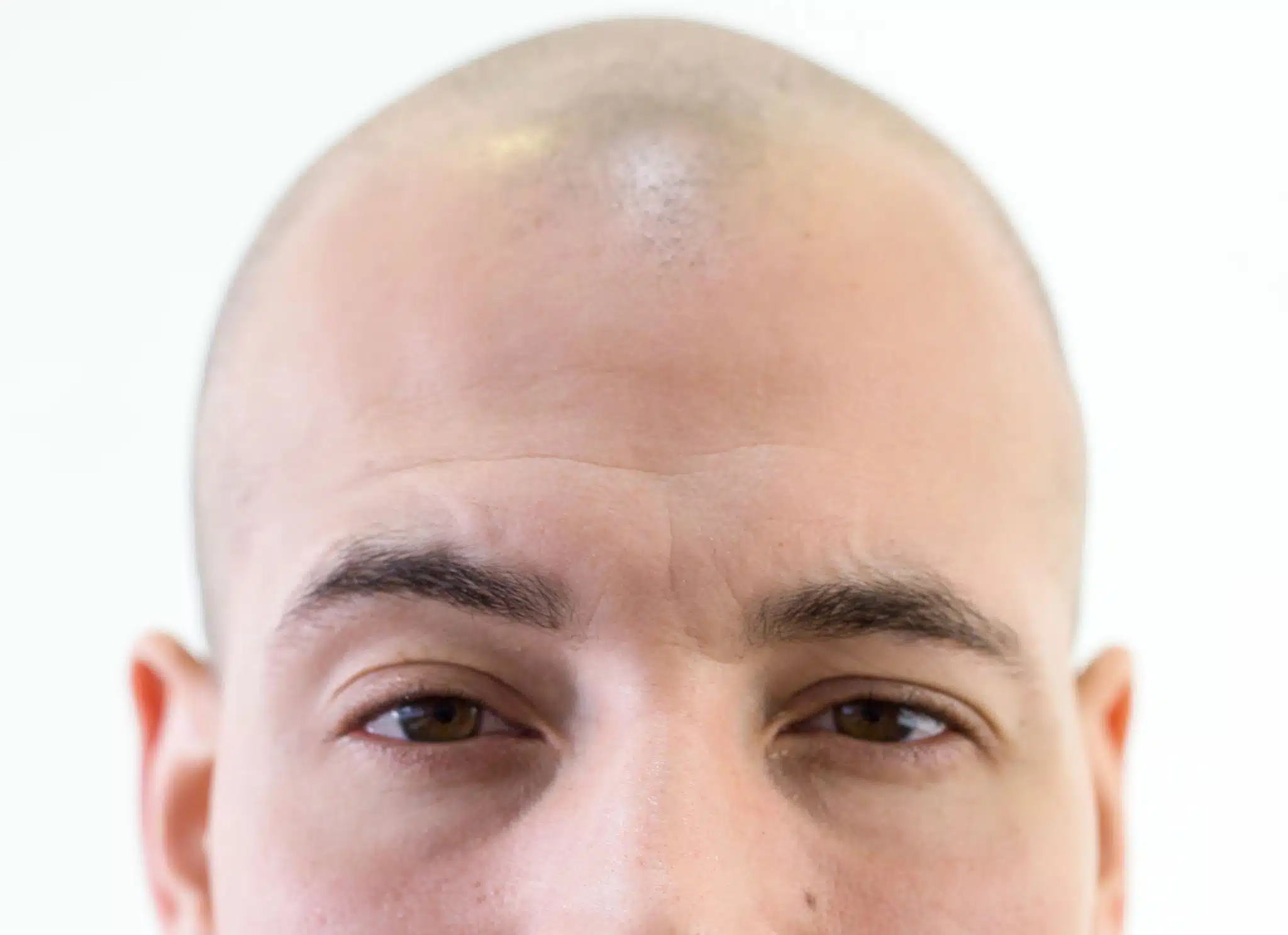 Before SMP treatment for men