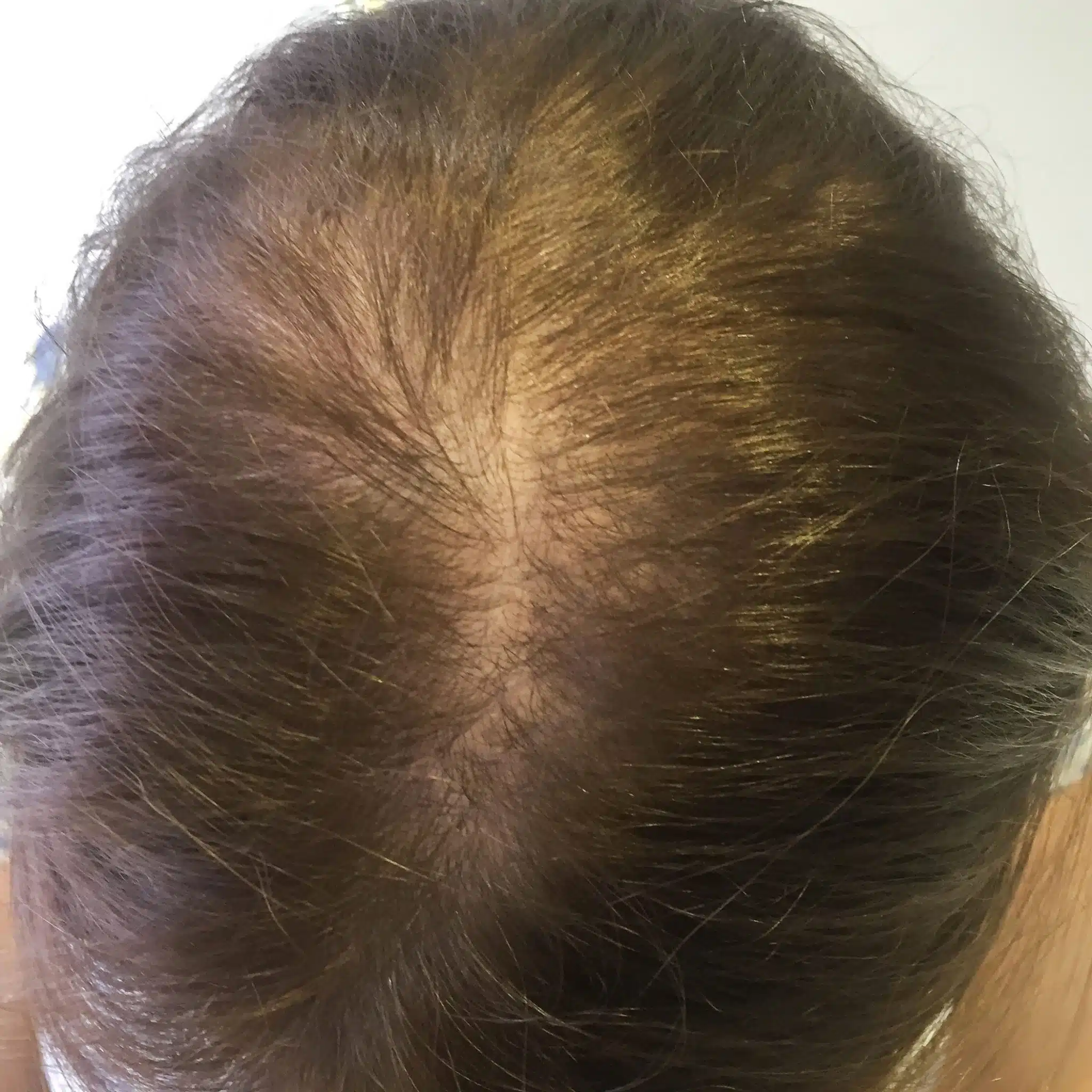 Before SMP treatment for women