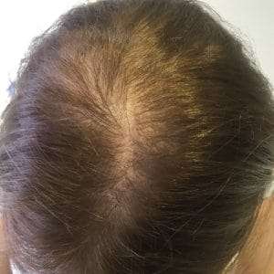 Woman in need of scalp micropigmentation