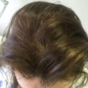 woman after smp for women