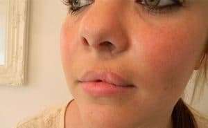 cleft lip scar camouflage manchester