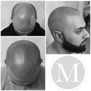 before and after scalp micropigmentation by marcia