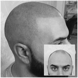 man with scalp micropigmentation done by marcia manchester