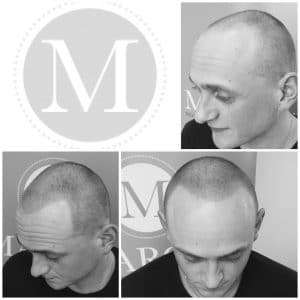 Mans density treatment with scalp micropigmentation in manchester