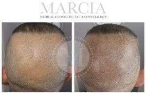 Scalp microblading b4 & After 05