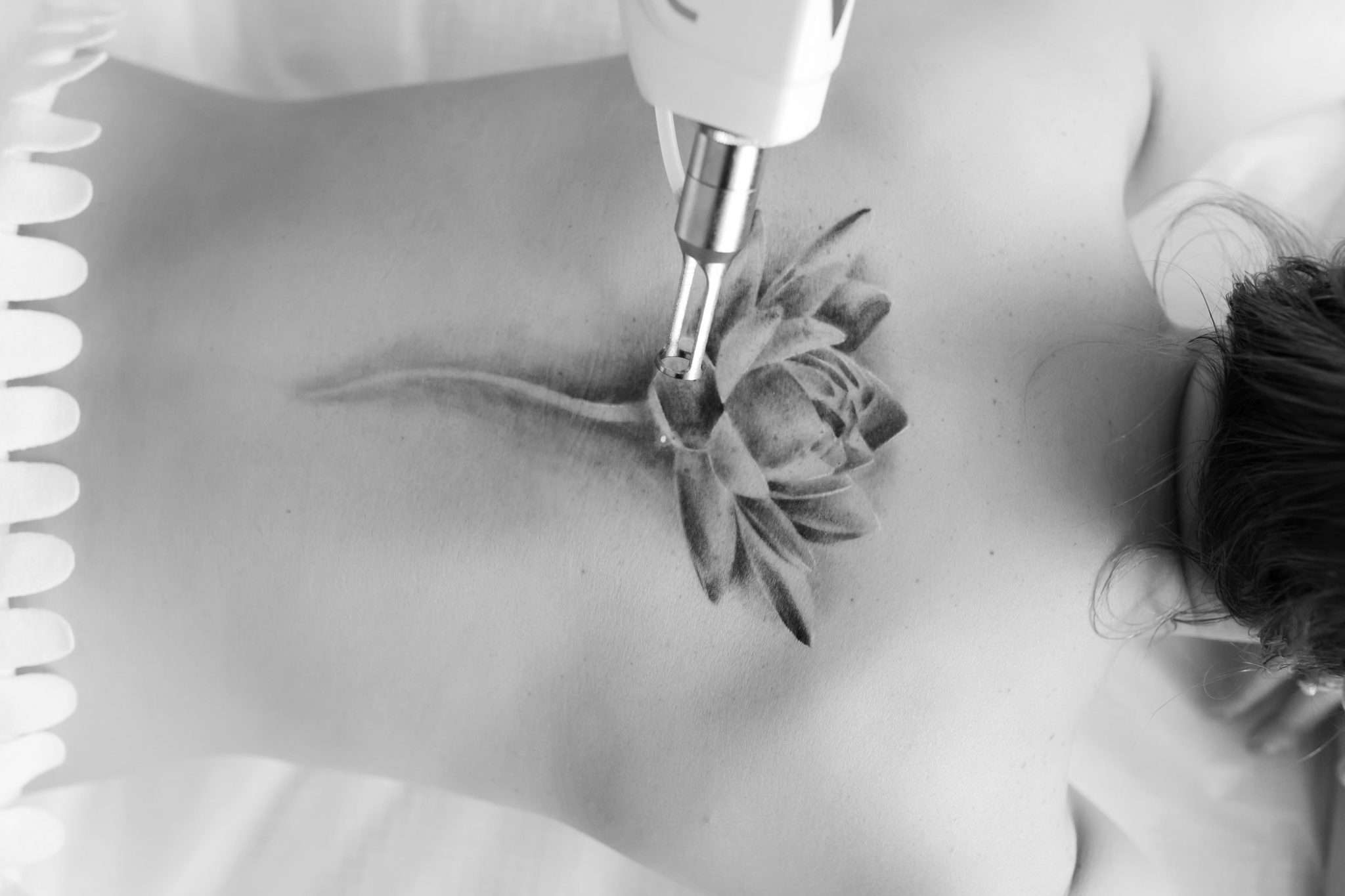 woman having tattoo removal manchester